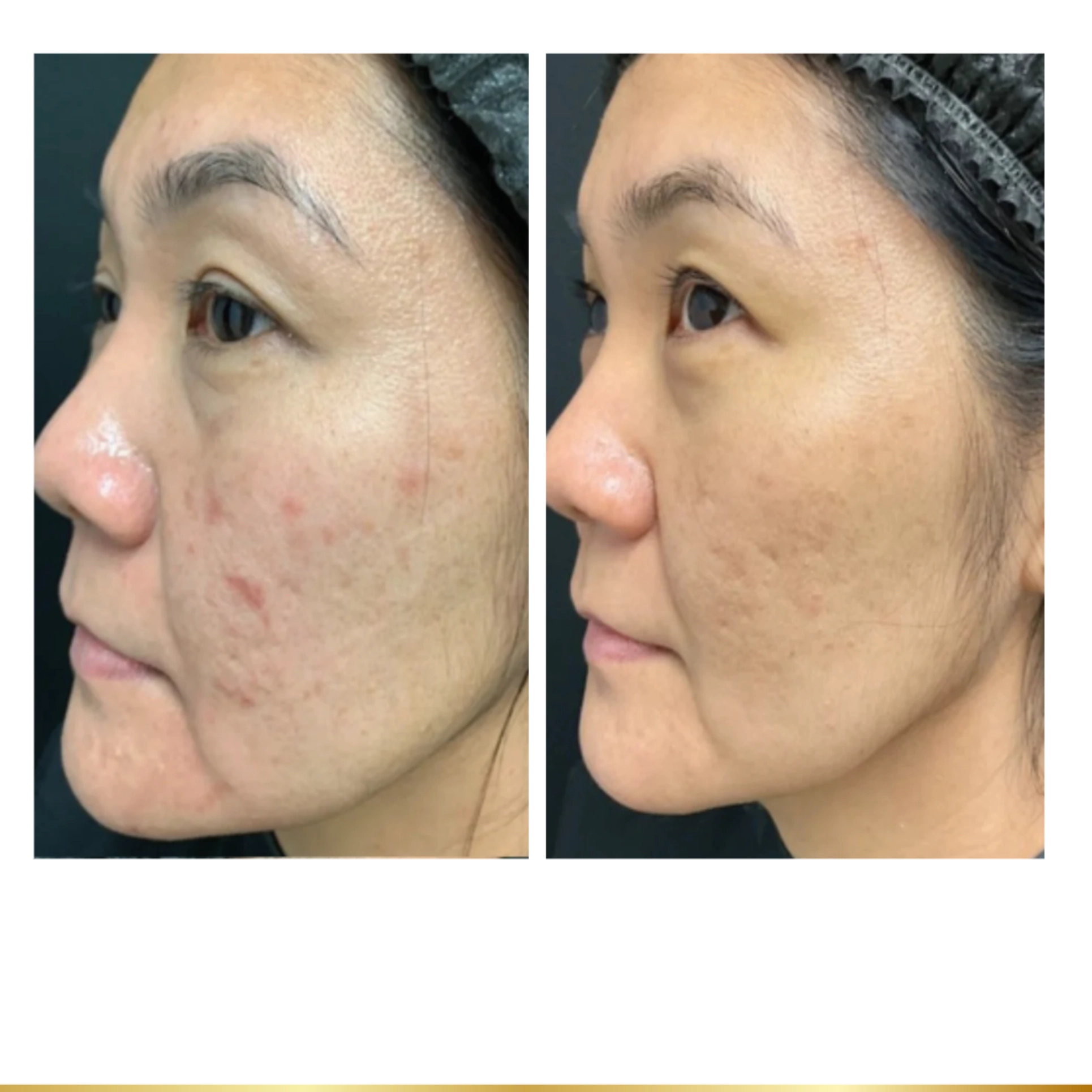 Before and after results of facial treatment showing reduced acne scars and smoother skin texture with mesoneedling
