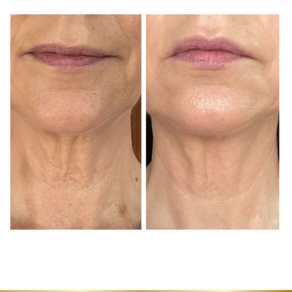 Before and after mesoneedling treatment on the lower face and neck.