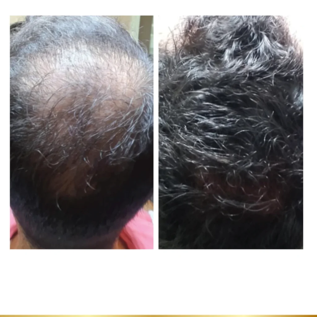 Before and after results showing significant hair regrowth on scalp after mesoneedling treatment