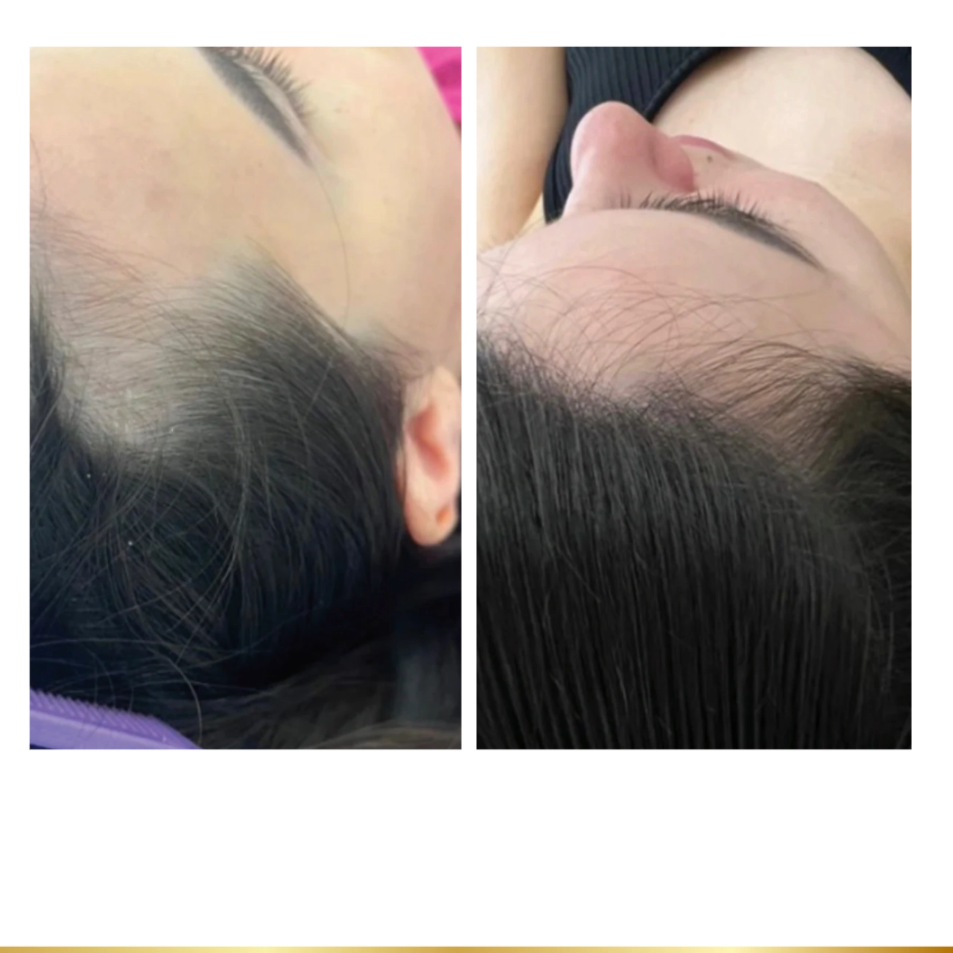 Before and after mesoneedling treatment on the hairline.